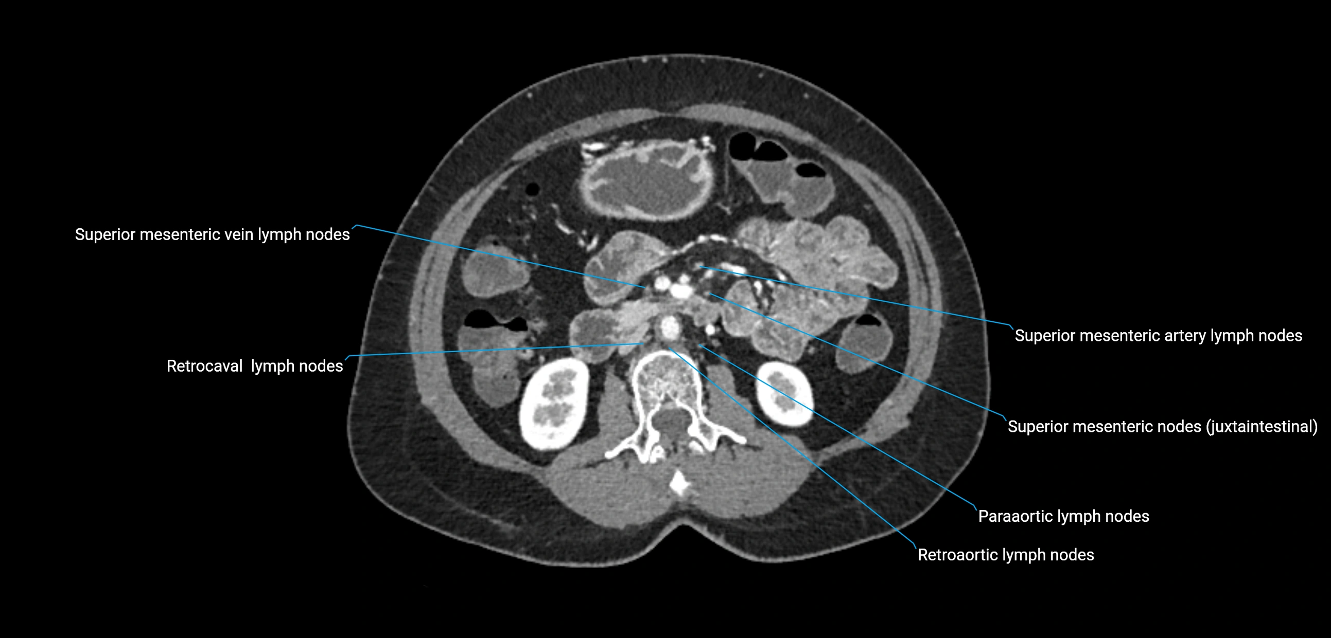 CT ct abdominal lymph nodes  axial cross sectional anatomy  enchanced radiology image -img-00002-00204.webp